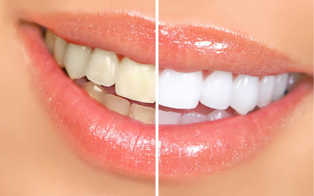 How Much Does Teeth Whitening Cost? What Are The Benefits?