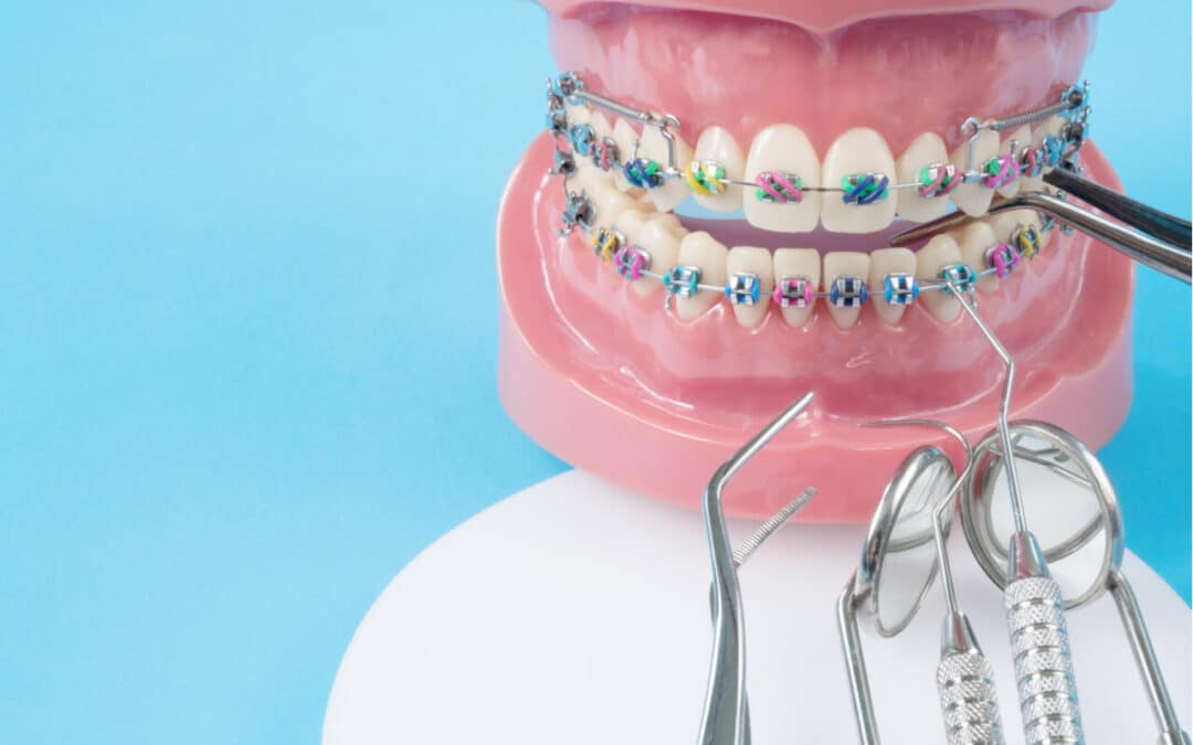 What Are DIY Braces? (And Why They Are Dangerous)