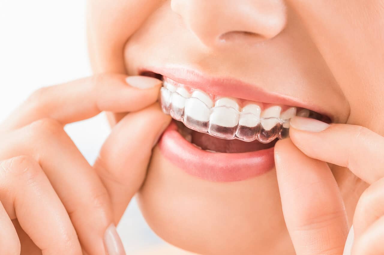 modern orthodontic aligners